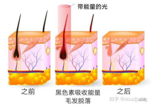 煥現(xiàn)絲滑肌膚｜榮獲設(shè)計(jì)大獎(jiǎng)的紅光強(qiáng)脈沖脫毛儀使用推薦